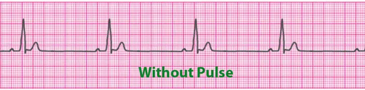 pulseless-electrical-activity-pea