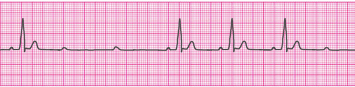 second-degree-atrioventricular-block-type-2-mobitz-2-hay