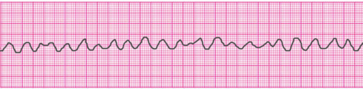 ventricular-fibrillation