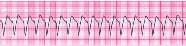 ventricular-tachycardia-monomorphic