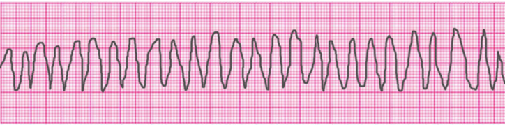 ventricular-tachycardia-polymorphic