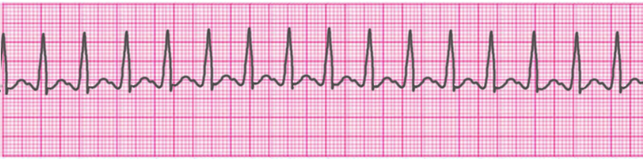 atrial-tachycardia