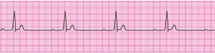 first-degree-atrioventricular-block