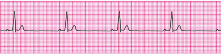 sinus-bradycardia