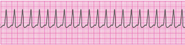 supraventricular-tachycardia
